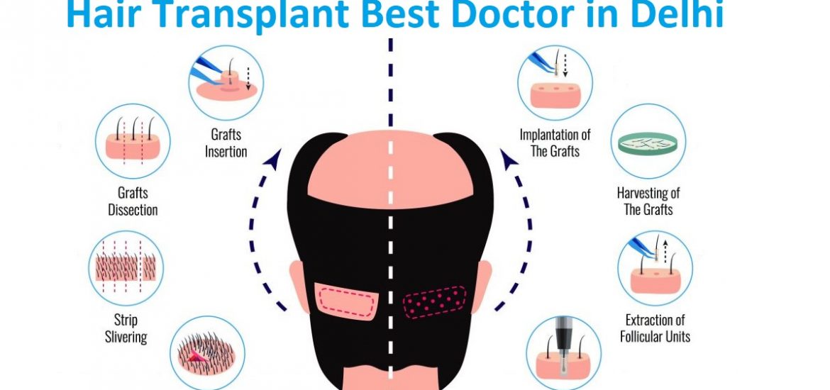 hair transplant