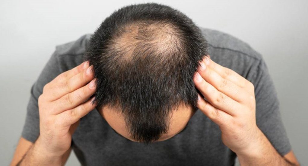 Hair Transplant