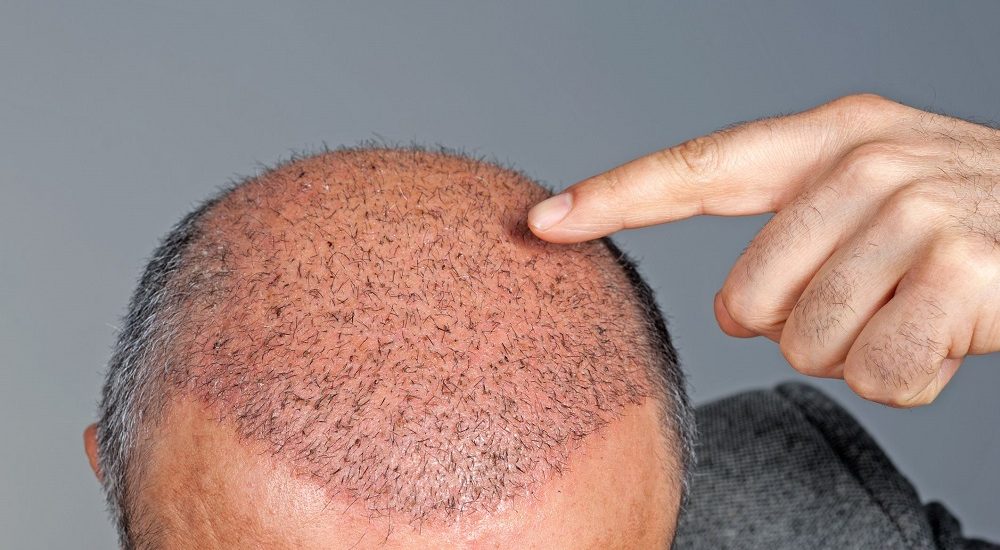 hair transplant