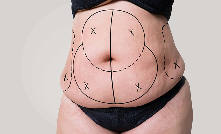 Tummy-Tuck-Surgery