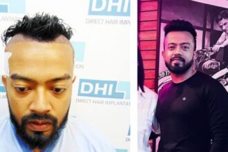 Swoujas’s Hair Transplant Journey with DHI India