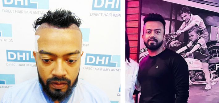 Swoujas’s Hair Transplant Journey with DHI India